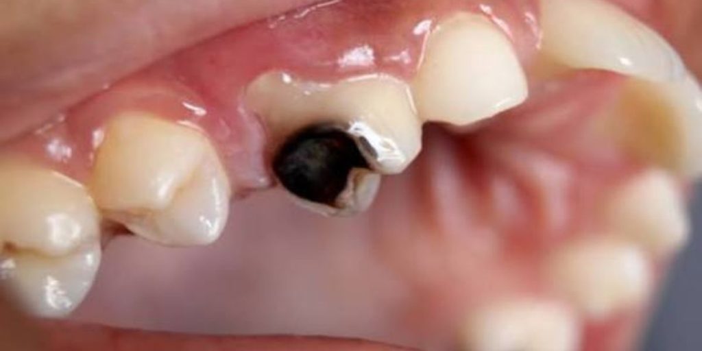 Dentist evaluating a damaged or infected tooth to determine whether extraction is necessary and discuss treatment options | When Is a Tooth Extraction Necessary